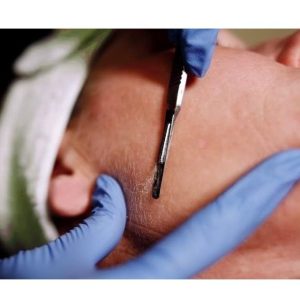 Swann - Morton - Number 10R Dermaplaning Blades - Image 4