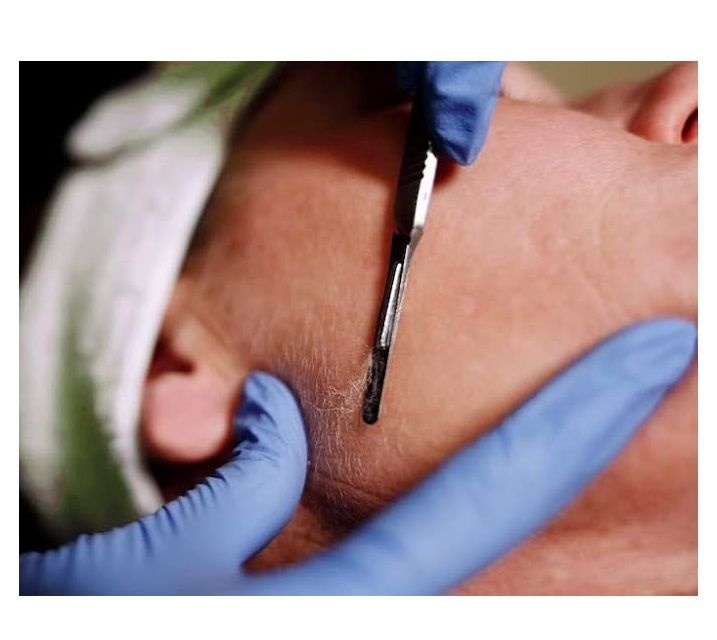 Swann - Morton - Number 10R Dermaplaning Blades